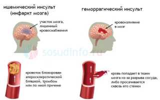 Инсульт восстановление после инсульта