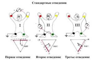 Снятие экг наложение электродов