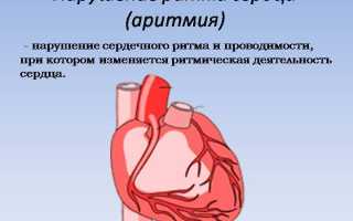 Лечение аритмии сердца