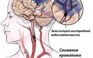 Ишемическая болезнь головного мозга симптомы