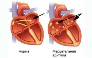 Причины возникновения мерцательной аритмии сердца