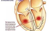 Классификация желудочковых экстрасистол по лауну