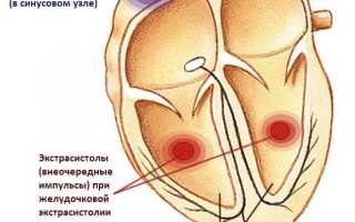 Классификация желудочковых экстрасистол по лауну