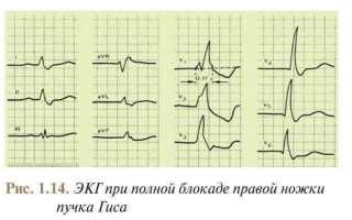 Блокада задней ветви левой ножки пучка гиса