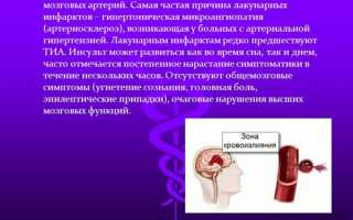 Лакунарный инфаркт