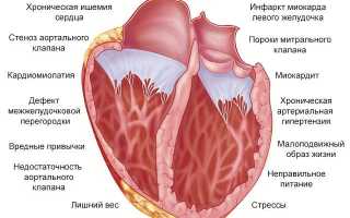 Причина смерти левожелудочковая недостаточность