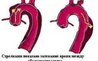 Пульсация брюшной аорты причины