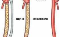 Закупорка сосудов на ногах лечение