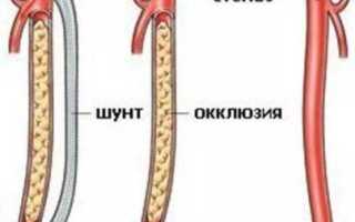 Закупорка сосудов на ногах лечение