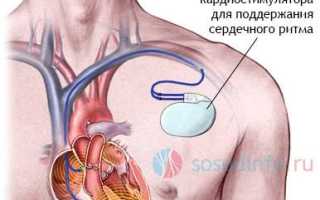 Брадикардия сердца что это такое