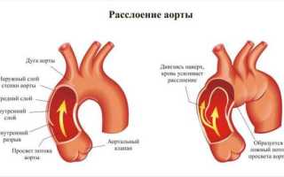 Уплотнение аорты сердца