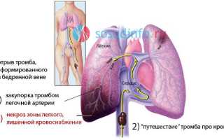 Тромбоэмболия легких что это такое
