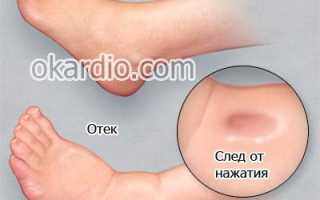 Отек ног при сердечной недостаточности