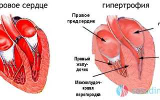 Атрофия левого желудочка