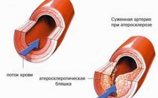 Уплотнение корня аорты