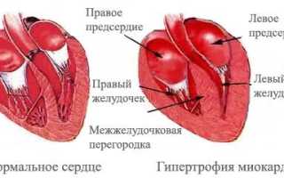 Гипертрофия левого желудочка лечение