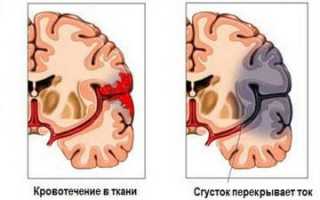 Геморрагический инсульт прогноз выздоровления