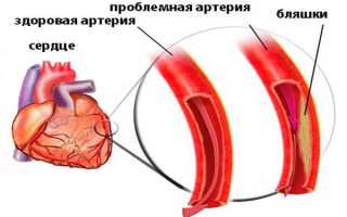 Боли при стенокардии какие