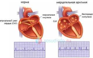 Мерцалка сердца что это
