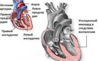 Симптомы миокардита